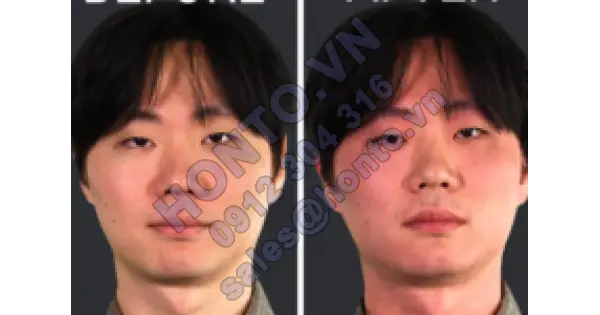 Tại sao nhiều người đỏ mặt khi uống rượu bia